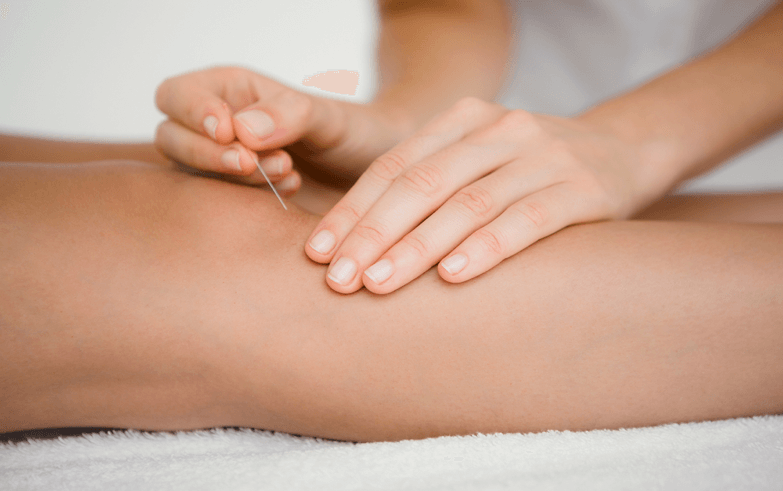 Dry-Needling